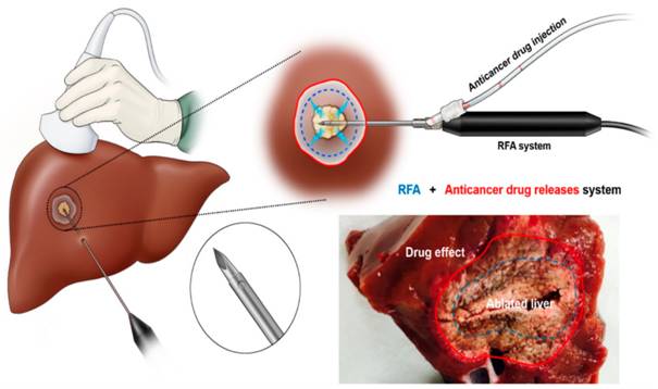 Applied Sciences | Free Full-Text | Feasibility of a Drug-Releasing  Radiofrequency Ablation System in a Porcine Liver Model