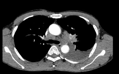 Case lâm sàng: điều trị ung thư phổi không tế bào nhỏ giai đoạn IV di căn màng phổi tại Bệnh viện Ung bướu Thanh Hóa