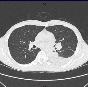 A close-up of a chest x-ray

Description automatically generated