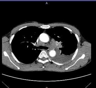 A close-up of a chest x-ray

Description automatically generated