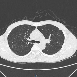 A close-up of a chest x-ray

Description automatically generated