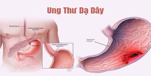 Khát quát về ung thư dạ dày