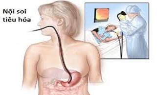 Sự cần thiết của quá trình nội soi tiêu hóa?