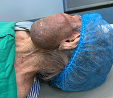 Phẫu thuật thành công khối ung thư khổng lồ vùng mặt cho cụ bà 99 tuổi tại Bệnh viện Ung bướu Thanh Hóa