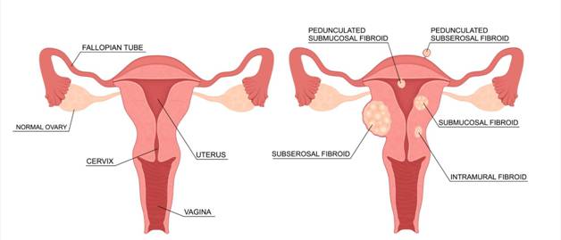 Four Types of Fibroids and Their Location | AFC