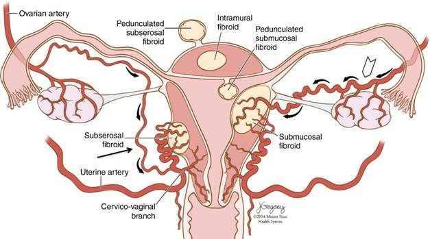 Management of Uterine Fibroids: A Focus on Uterine-sparing Interventional  TechniquesRadiology