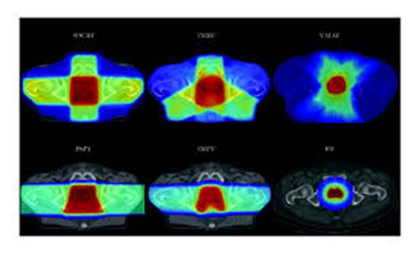 Examples of dose distribution of a 3DCRT, IMRT-5, VMAT, PSPT, IMPT, and...  | Download Scientific Diagram