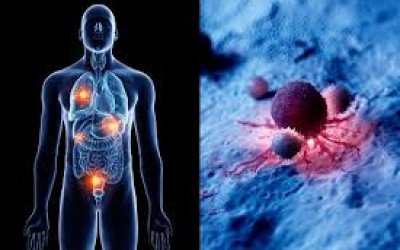 Dự phòng thuyên tắc huyết khối tĩnh mạch ở bệnh nhân điều trị nội khoa ung thư
