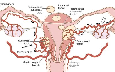 Nút mạch điều trị u xơ tử cung– Giải pháp điều trị xâm lấn tối thiểu bảo tồn tử cung