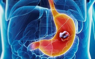 Ung thư dạ dày – phát hiện sớm để điều trị triệt căn