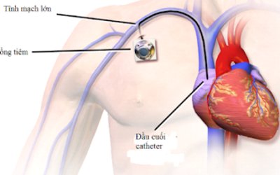 Đặt cổng truyền hóa chất dưới da dưới hướng dẫn hệ thống DSA – Giải pháp tiếp cận tĩnh mạch lâu dài cho người bệnh điều trị ung thư.