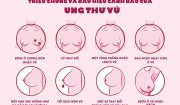 Phẫu thuật bảo tồn tuyến vú tại Bệnh viện Ung bướu tỉnh Thanh Hoá