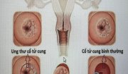 Phẫu thuật ung thư cổ tử cung tại bệnh viện Ung bướu tỉnh Thanh Hoá   