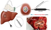 Đốt sóng cao tần (RFA) điều trị ung thư gan tại  Bệnh viện Ung bướu tỉnh Thanh Hóa