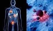 Dự phòng thuyên tắc huyết khối tĩnh mạch ở bệnh nhân điều trị nội khoa ung thư