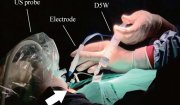 Đốt sóng cao tần (RFA) – Giải pháp điều trị hiện đại, ít xâm lấn cho bệnh nhân nhân tuyến giáp lành tính