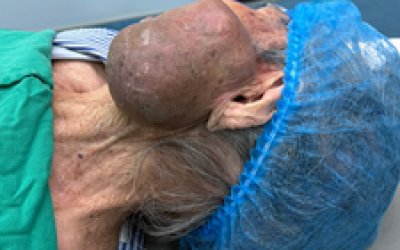 Phẫu thuật thành công khối ung thư khổng lồ vùng mặt cho cụ bà 99 tuổi tại Bệnh viện Ung bướu Thanh Hóa