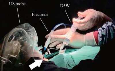 Đốt sóng cao tần (RFA) – Giải pháp điều trị hiện đại, ít xâm lấn cho bệnh nhân nhân tuyến giáp lành tính
